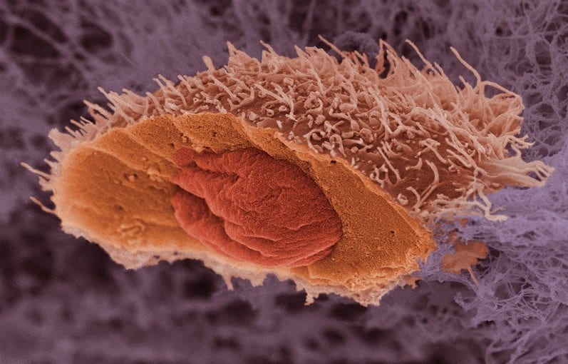 Cell from a squamous cell carcinoma